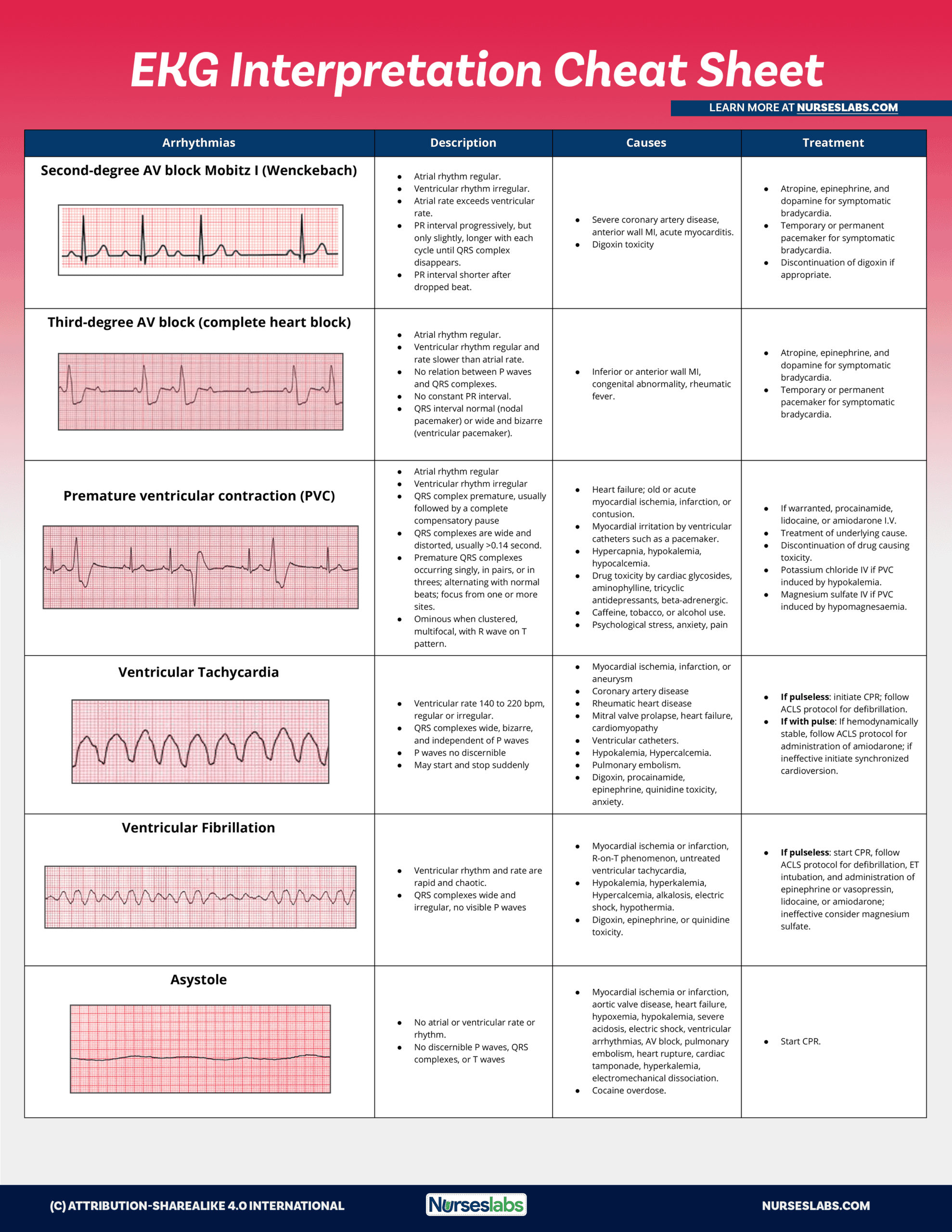 EKG Interpretation Cheat Sheet & Heart Arrhythmias Guide ( Update) EKG Interpretation Cheat Sheet & Heart Arrhythmias Guide ( Update)